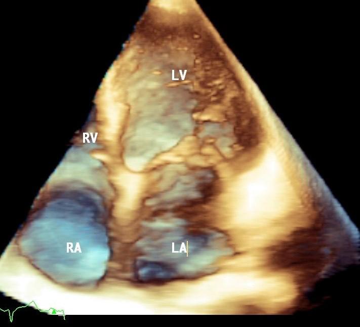 Echocardiography Test in Chandigarh