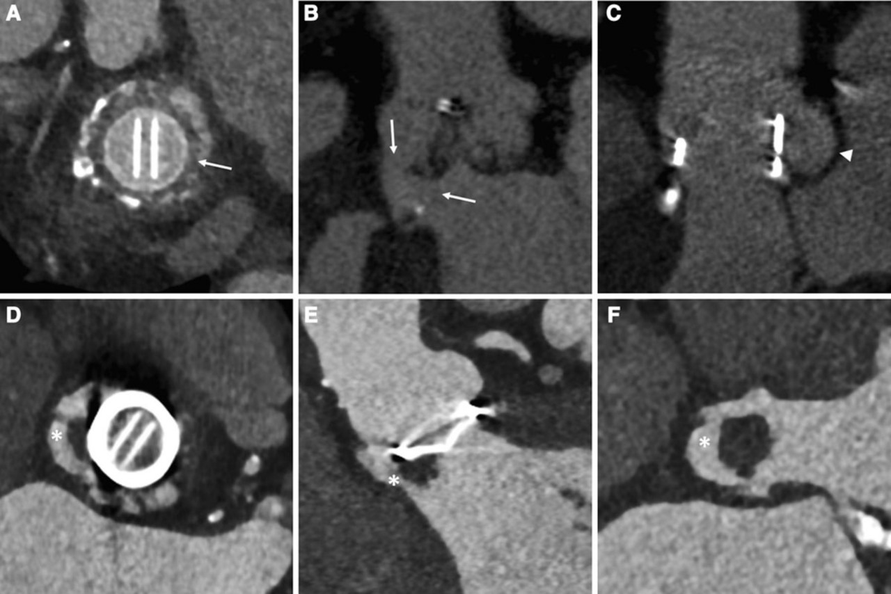 Unlocking Insights ASE 2024 Guidelines on Prosthetic Valve Assessment Echo Singh