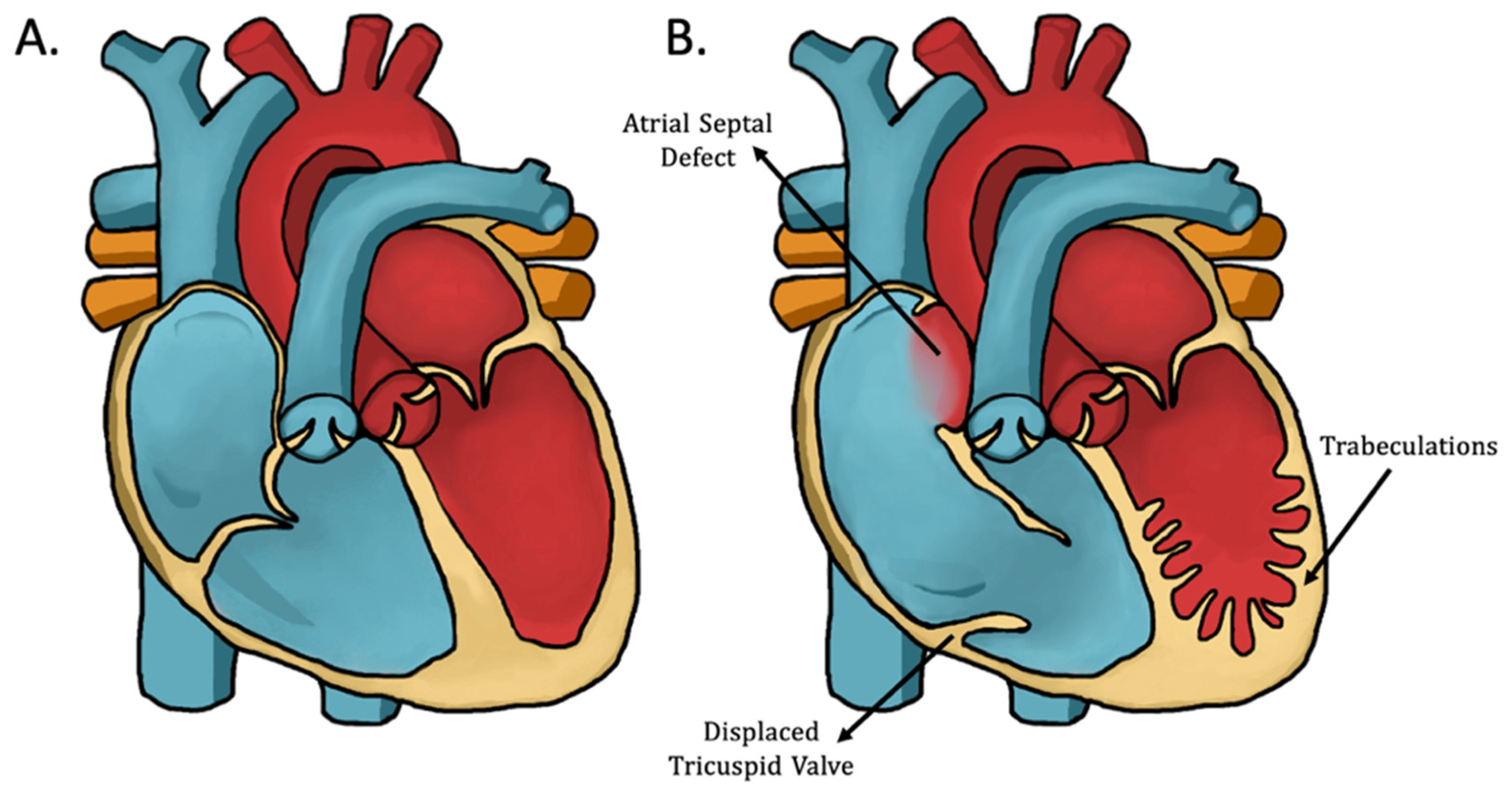 Understanding Fetal Ebstein Noncompaction: Insights from Clinical Case ...